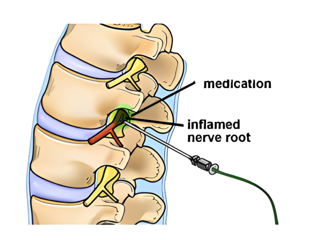 Medication Disc Slipped Disc Treatment Specialist - Delhi Pain Management Centre