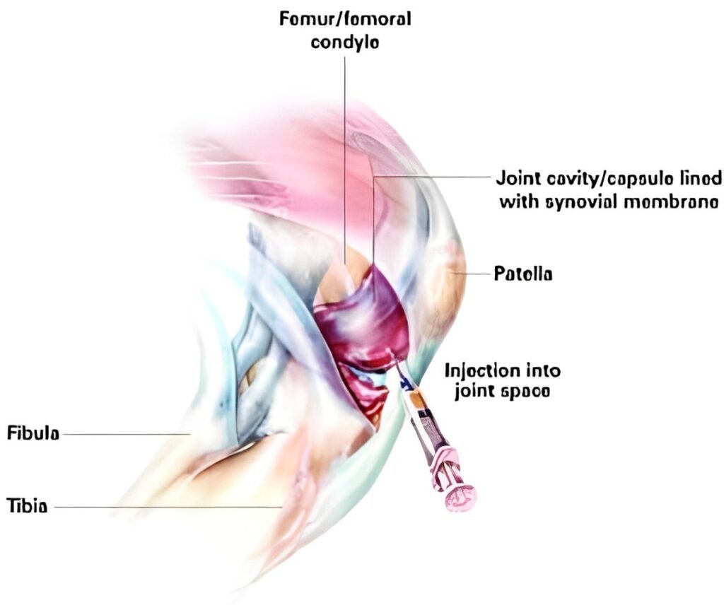 Ozone Injections for Pain Relief - Delhi Pain Management Centre